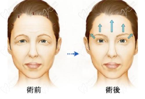 超声炮抗衰
