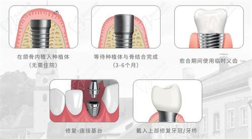 石家庄中诺口腔医院种植牙怎么样