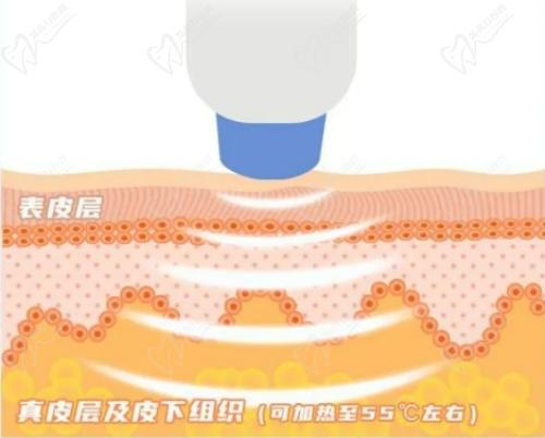 成都画美整形热玛吉技术娴熟
