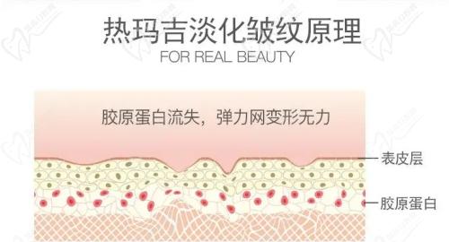 成都画美整形做热玛吉的口碑不错