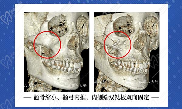 罗金超做颧骨风格