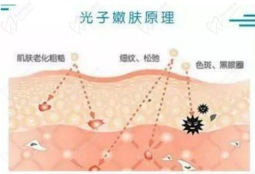 成都素美医疗整形医院做光子嫩肤技术高超