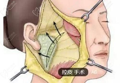 聂云飞医生在拉皮手术方面的优势