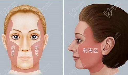 蒙石南拉皮和聂云飞拉皮手术价格参考