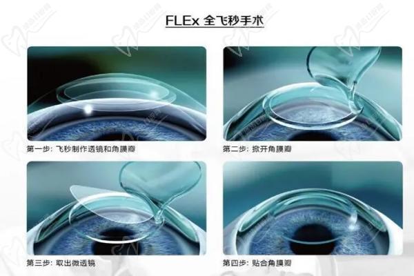 遵义恒爱眼科医院近视手术