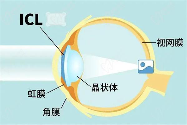 海口康伟眼科ICL晶体植入近视手术价格
