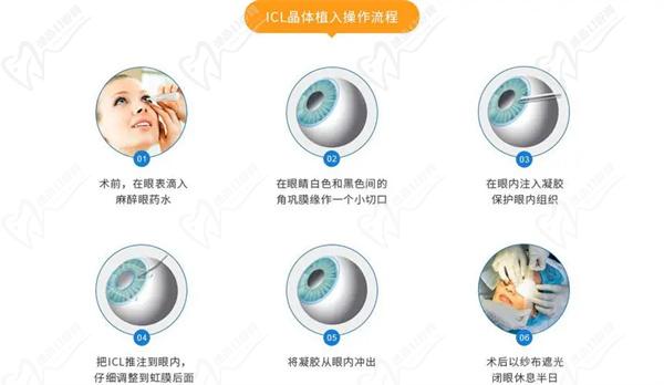 人工晶体植入