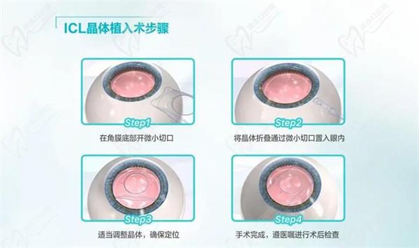 人工晶体植入