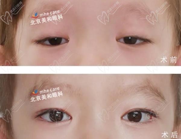 双眼上睑下垂，手术后做成双眼皮