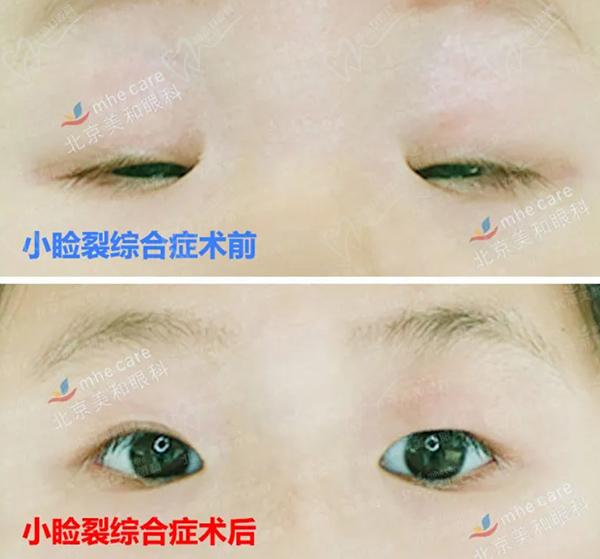 小睑裂综合征手术前后对比图