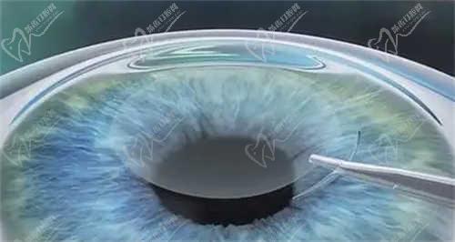 天津滨海国泰眼科医院做近视手术口碑好吗？