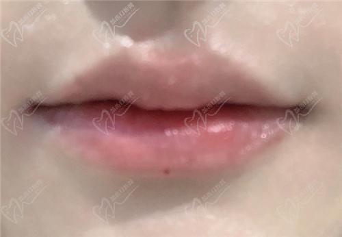 郑州缔莱美张继医生玻尿酸丰唇范例