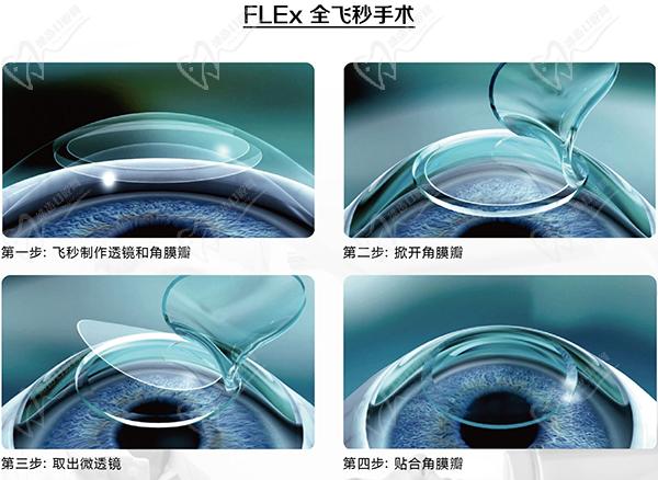 长沙全飞秒手术价格一览表