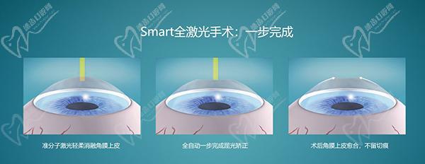 长沙半飞秒激光近视手术价格