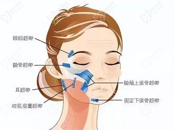 筋膜提升
