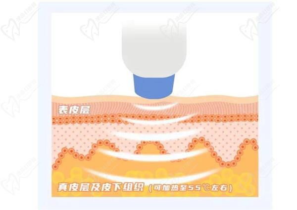 热玛吉