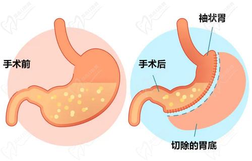 什么是袖状胃切除术？