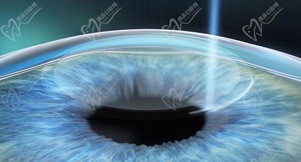 长沙裕湘医院眼科全飞秒近视手术怎么样