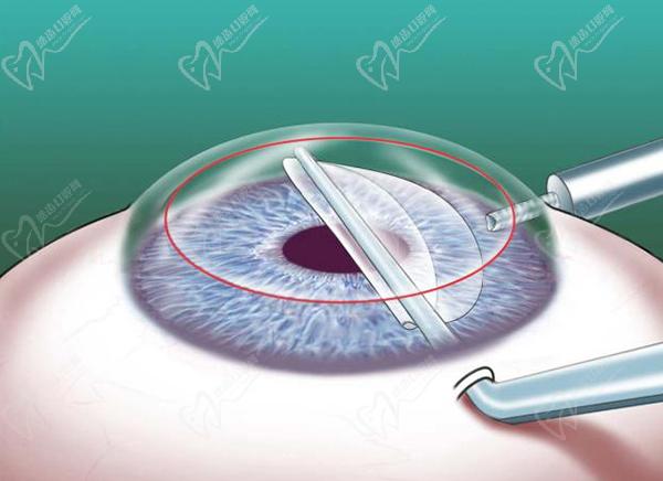 TICL晶体植入手术的利与弊