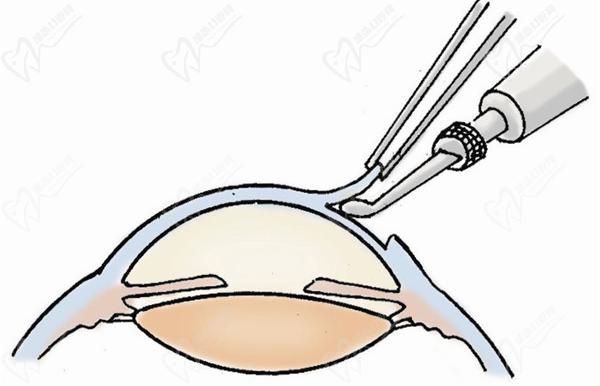 TICL晶体植入手术的利与弊