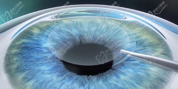 TICL晶体植入手术的利与弊
