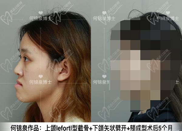 何锦泉医生的正颌手术水平怎么样