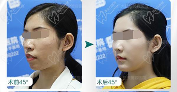 何锦泉正颌手术真的让我惊艳到