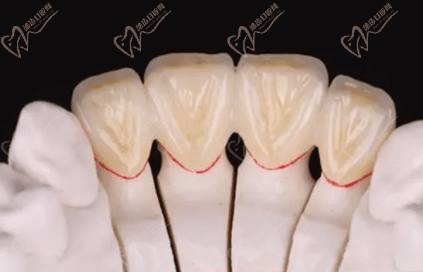 成都中诺口腔医院爱尔创全瓷牙1788元起