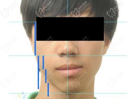 广州广大医院何锦泉偏颌手术价格