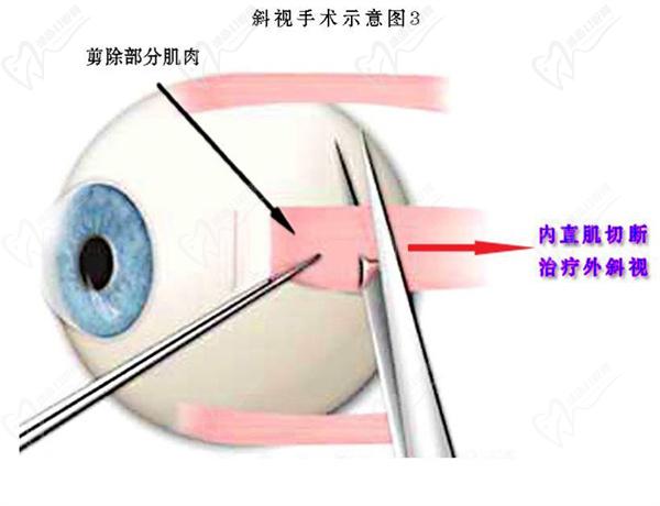 斜视手术