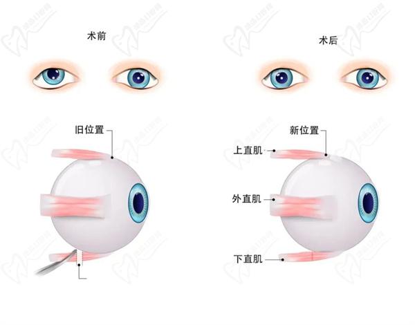 斜视手术