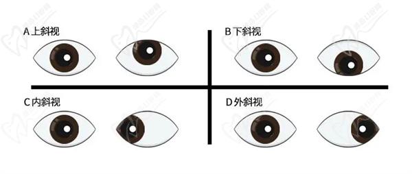 斜视手术