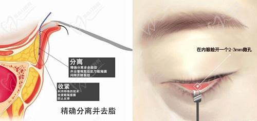 张晋宝做眼袋怎么样