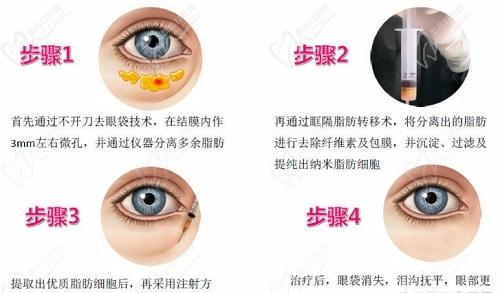 张晋宝做眼袋流程