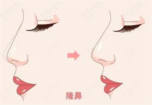 王志医生做鼻部综合整形手术的技术特点是什么？