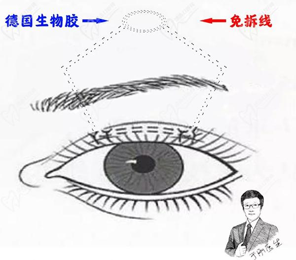 美和眼科于刚做上眼睑下垂手术MTS