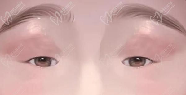 北京美和医院上眼睑下垂手术怎么样