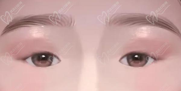 北京美和医院上眼睑下垂手术怎么样