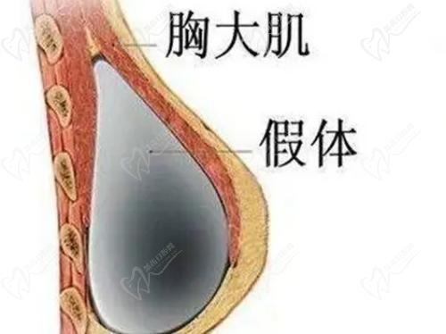 成都军大整形医院做曼托假体隆胸手术很自然