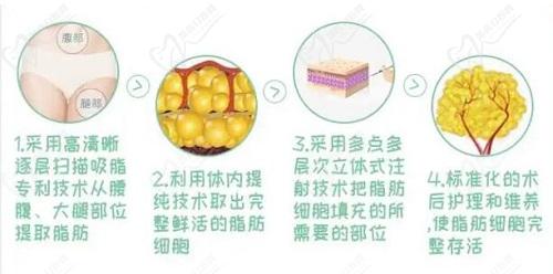 孙泽芳自体脂肪丰胸怎么样？