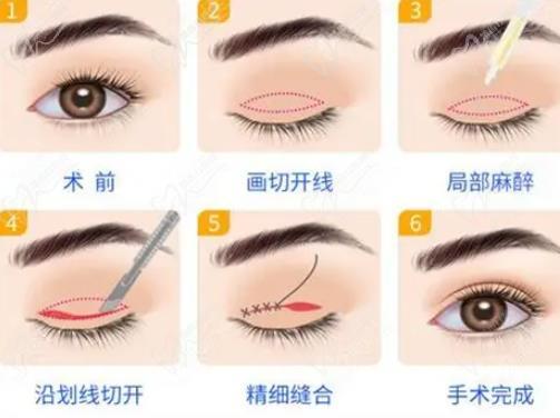 田跃平做双眼皮如何 田跃平做双眼皮如何