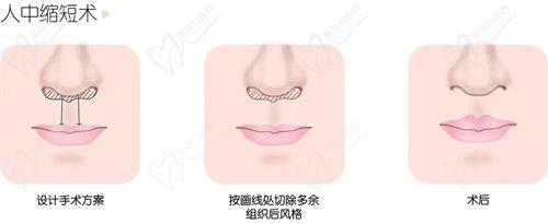 深圳福雅胡俊杰做人中缩短技术优势