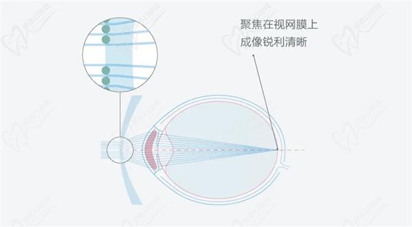 离焦镜
