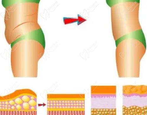 广州韩妃杨熙雯吸脂