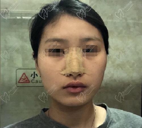 广州韩妃崔东做鼻子口碑