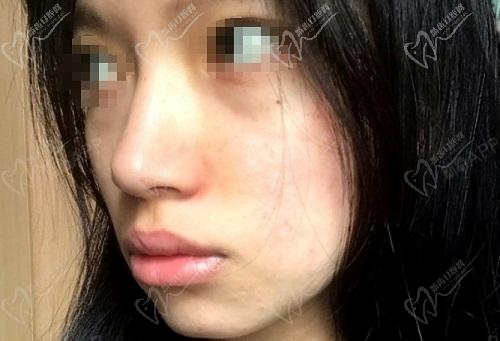 广州韩妃崔东做鼻子口碑评价