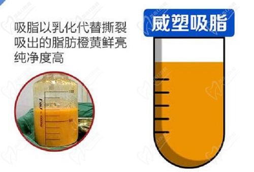 成都华生铂悦吸脂真的可以不用穿塑身衣吗?