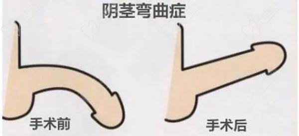 丁丁向下弯矫正手术多少钱