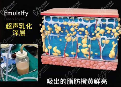 成都郑博晨吸脂价格