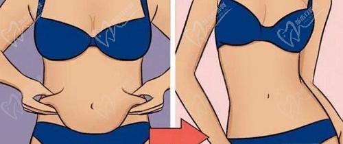 厦门华美整形腰/腹吸脂价格